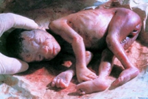 Chemical Abortion Picture