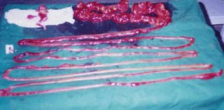Photo Showing Resected Coils Of Intestine